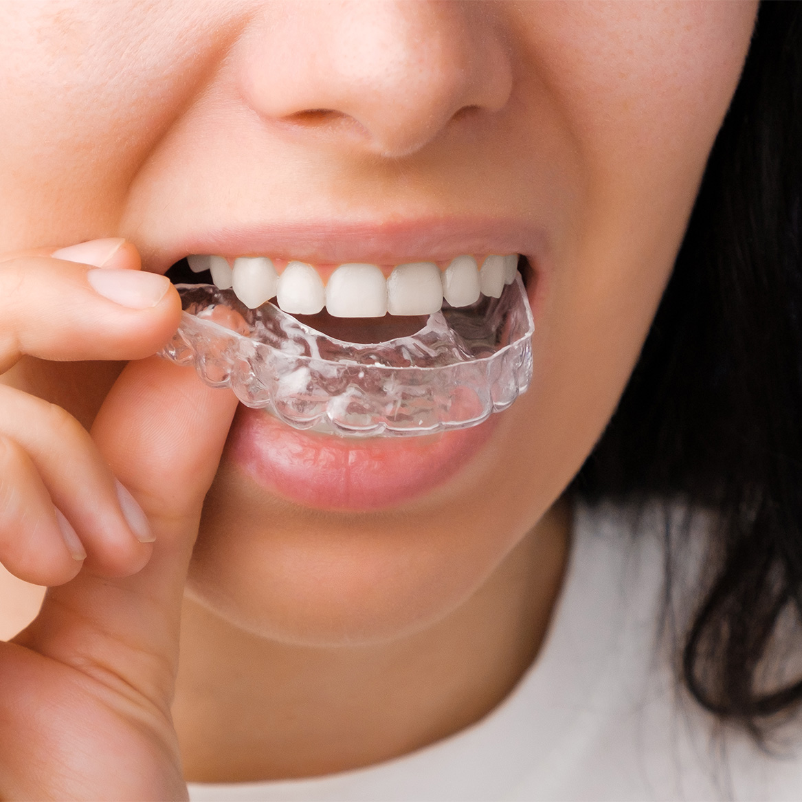 Ortodoncia Invisible con Invisalign